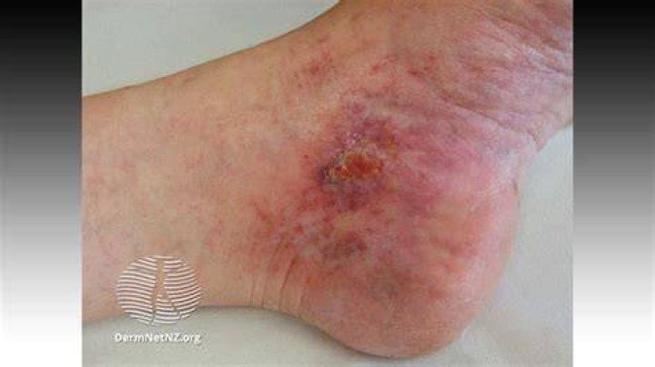 Cutaneous Clues Linked to COVID-19 Coagulation Risk