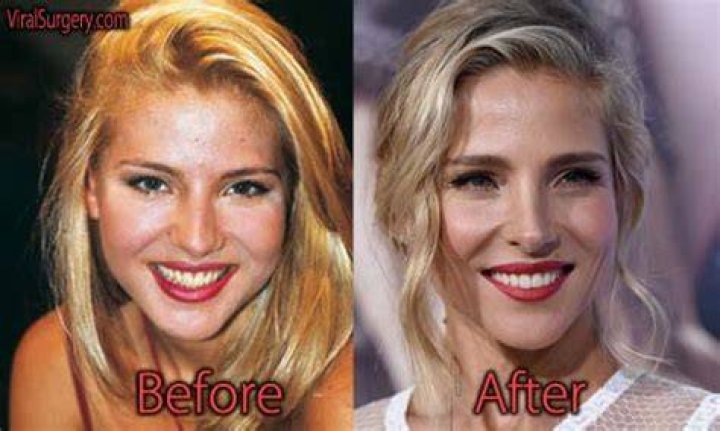 Elsa Pataky Nose Job Plastic Surgery Before and After