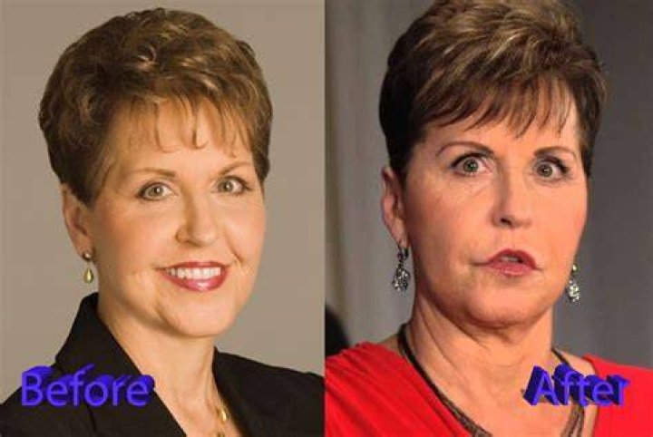Joyce Meyer Lip Augmentation Plastic Surgery Before and After