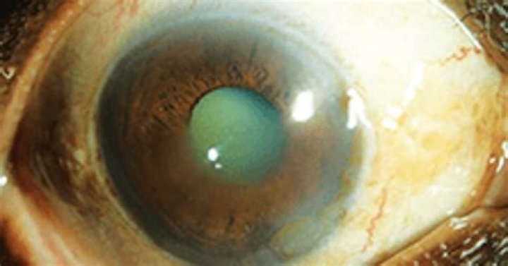 Sutureless Conjunctiva-Sparing Müllerectomy Is Promising